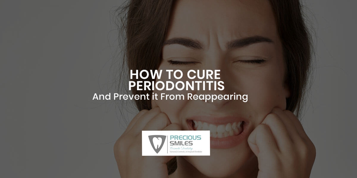 How to cure periodontitis, Periodontitis,