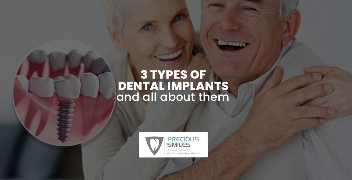 3 Types of Dental Implants and All About Them