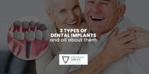 Read more about the article 3 Types of Dental Implants and All About Them