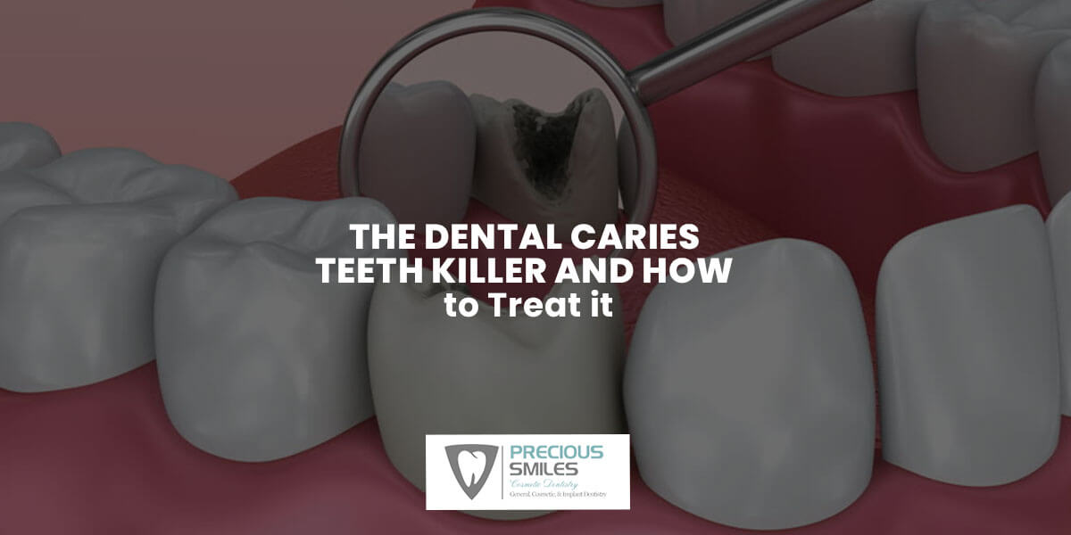 You are currently viewing The Dental Caries – Teeth Killer and How to Treat it.