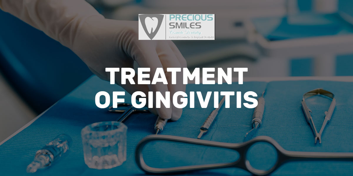 You are currently viewing Treatment of gingivitis