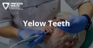 Read more about the article Yellow Teeth