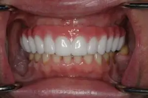 dental implant