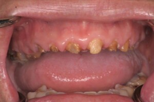 dental implants Miami Beach