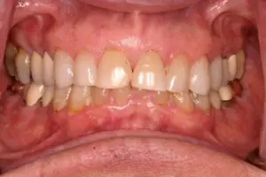 Before treatment – veneers candidate