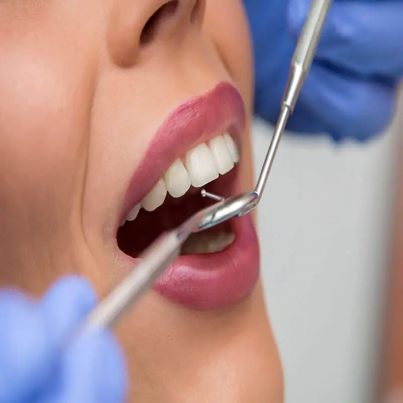 tooth discoloration