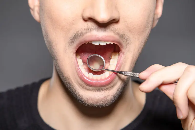 cavities