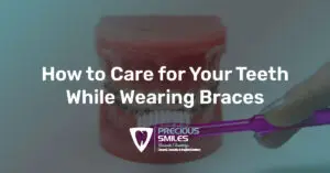 Read more about the article How to Care for Your Teeth While Wearing Braces
