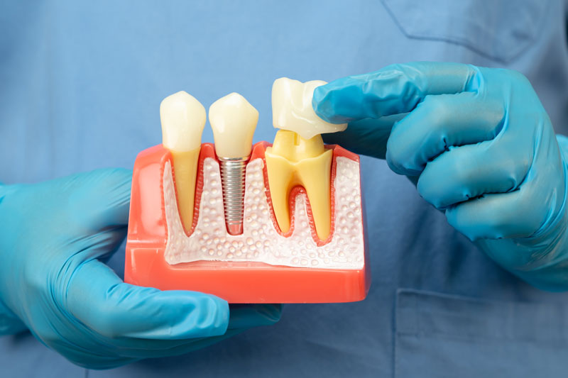The Dental Crown Procedure