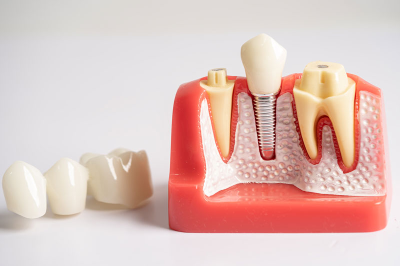 The Dental Crown Procedure