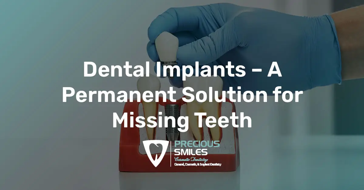 You are currently viewing Dental Implants – A Permanent Solution for Missing Teeth