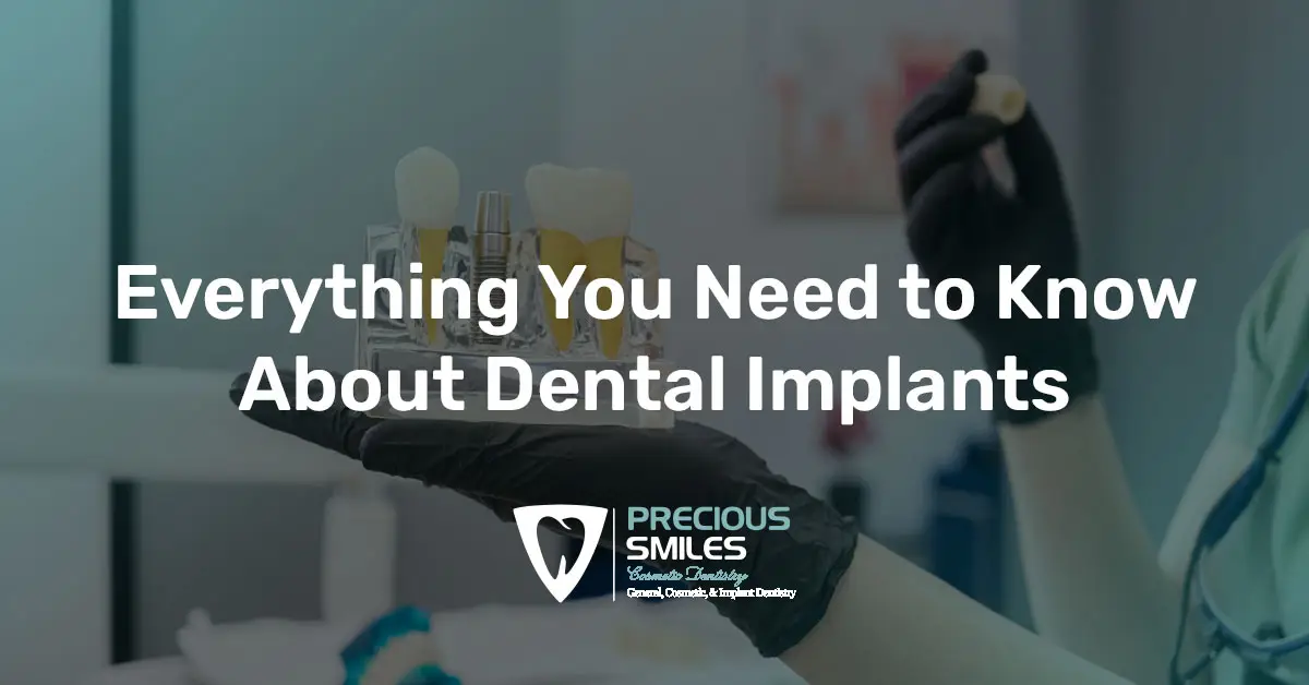 You are currently viewing Dental Implants – Everything You Need to Know Before Getting Them